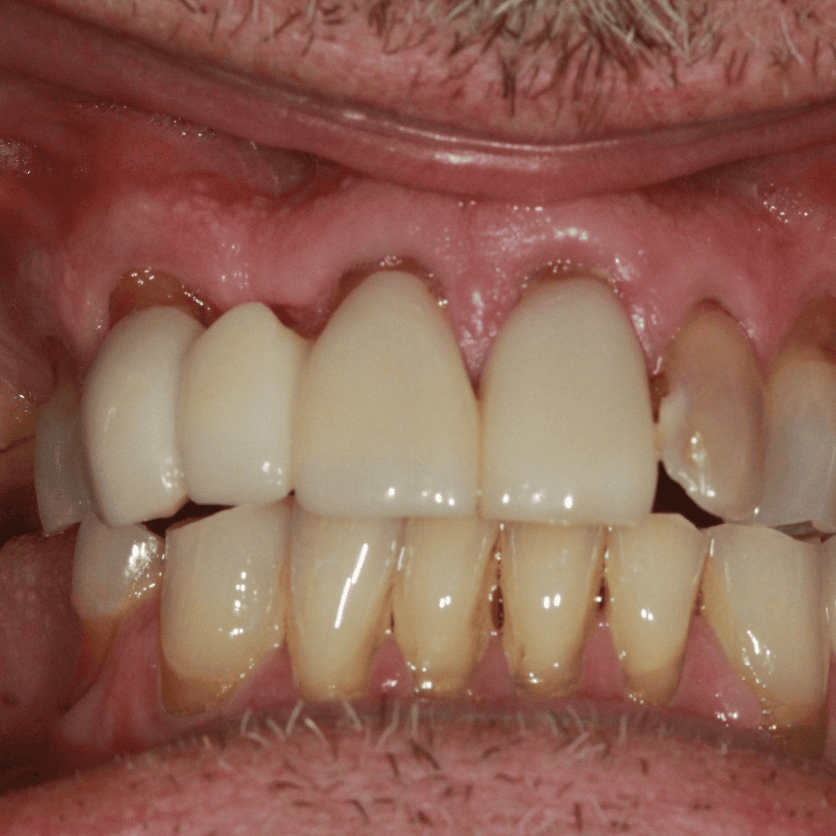 Close-up of dental implants and gums