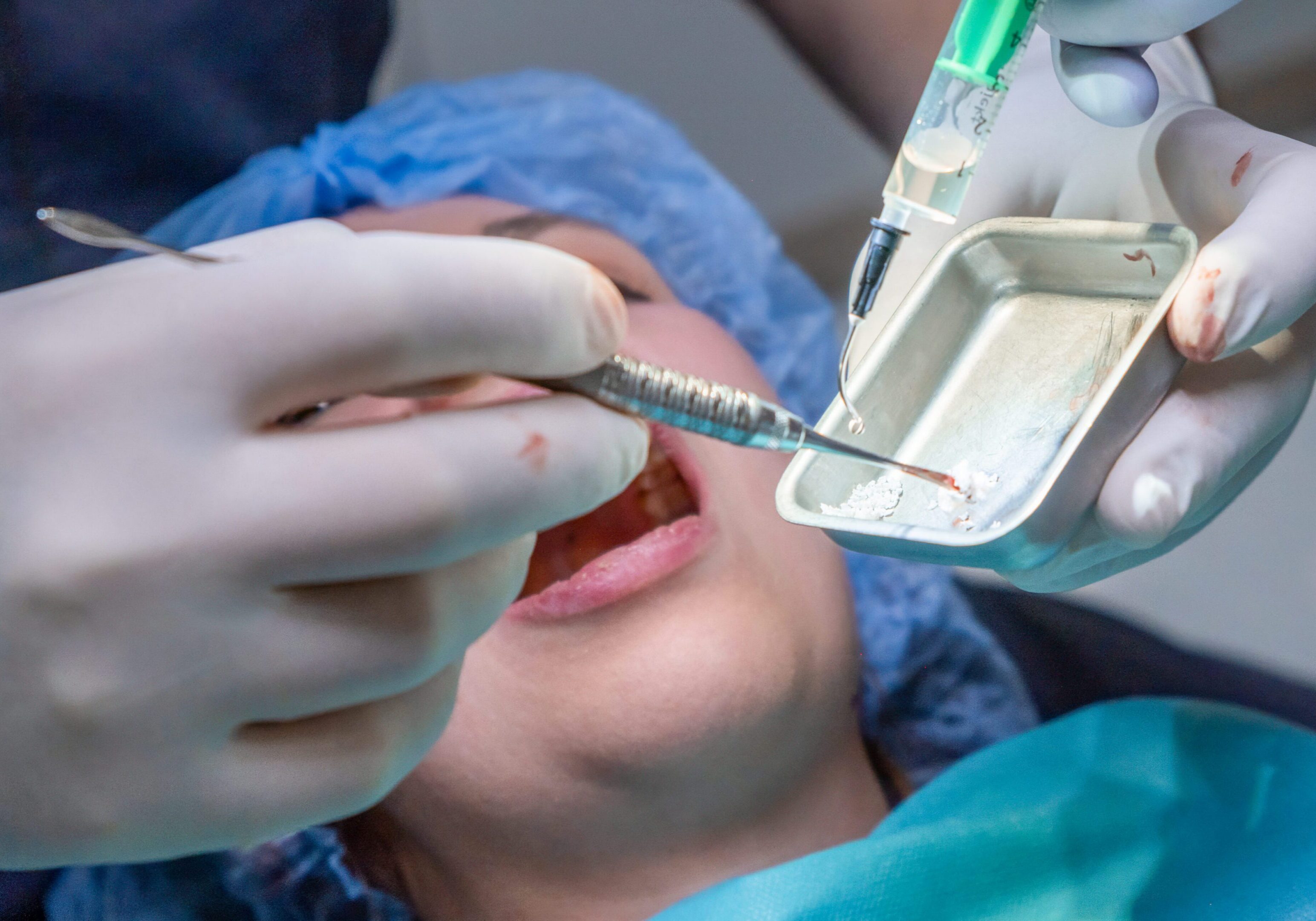 Dental team applies bone graft material into patient mouth during procedure. Instruments and suction tool assist in precise placement of material