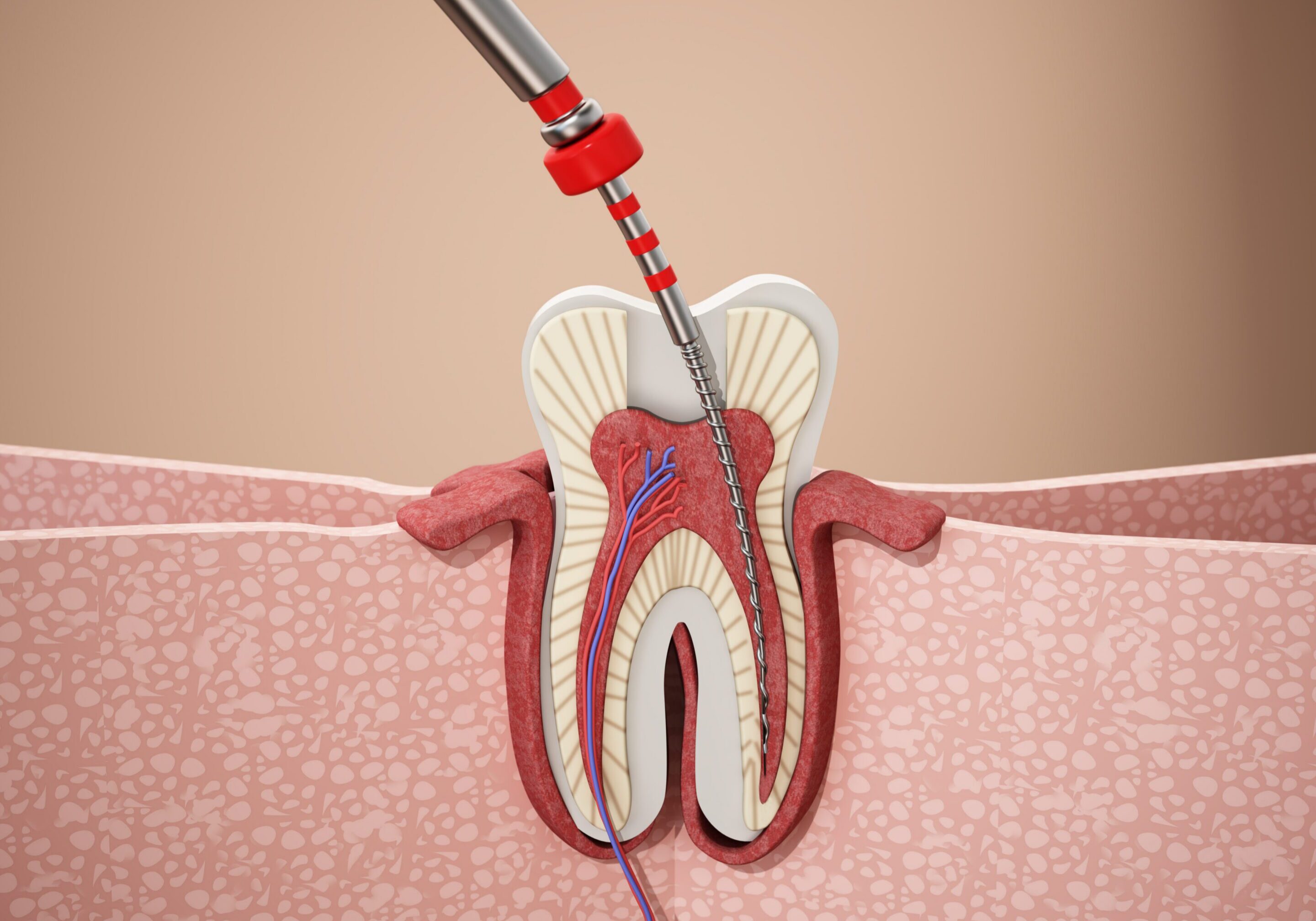 Dental procedure shows root canal treatment procedure with dental tools in a clinical setting on a neutral background.