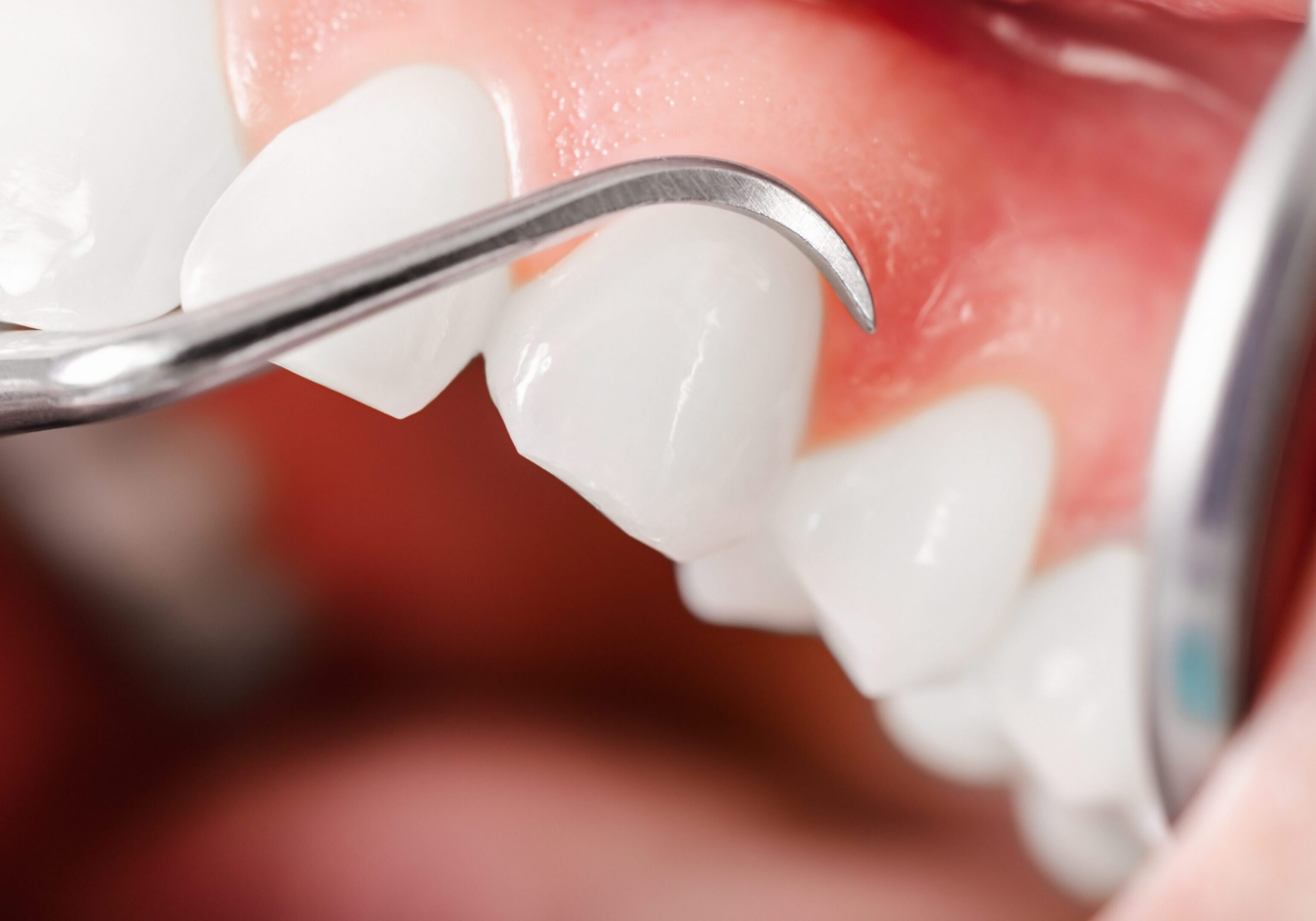 Dental cleaning with a scaler